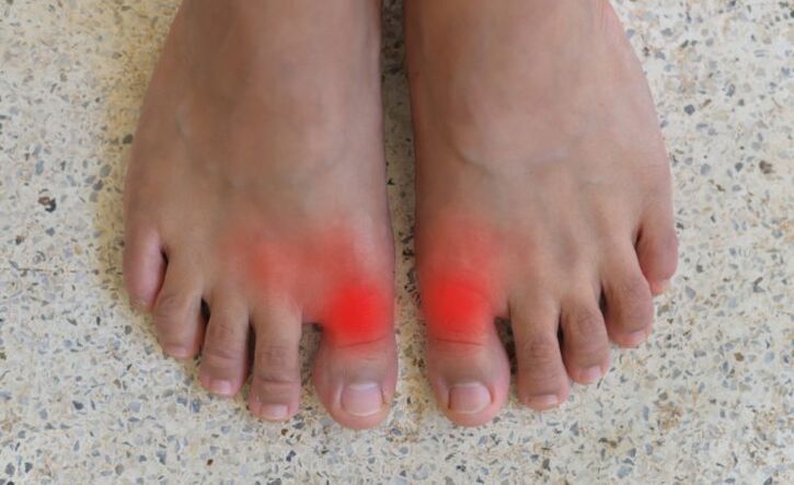 Πόνος στα μεγάλα δάχτυλα των ποδιών με ουρική αρθρίτιδα